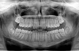 Types of X-rays